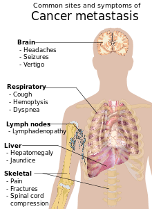 220px-Symptoms_of_cancer_metastasis.svg